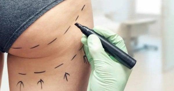 У Києві внаслідок операції з імплантації сідниць загинула 28-річна жінка.